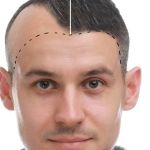Hair Transplant in Antalya: World-Class Treatment in a Mediterranean Paradise