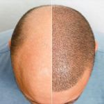 Hair Transplant Before and After: What Results Can You Expect?